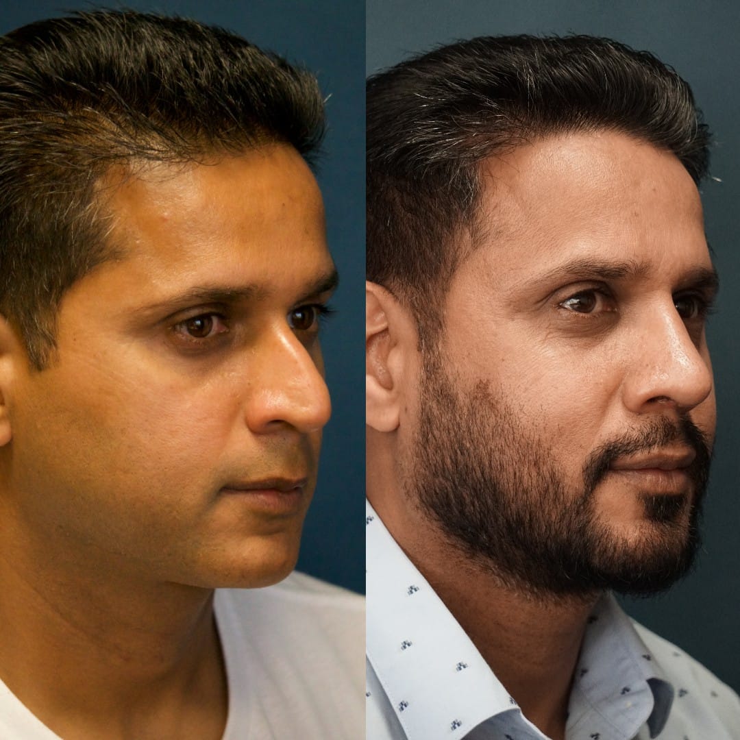 Revision Rhinoplasty Before & After Gallery - Patient 58241516 - Image 2