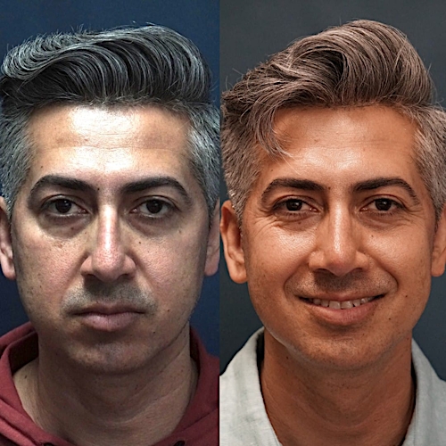 Rhinoplasty Before & After Gallery - Patient 58233332 - Image 2