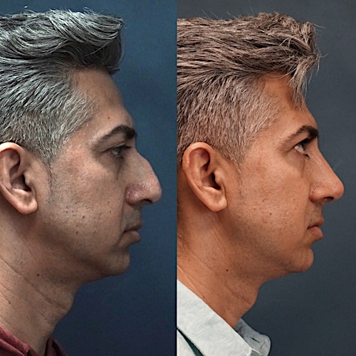 Rhinoplasty Before & After Gallery - Patient 58233332 - Image 1