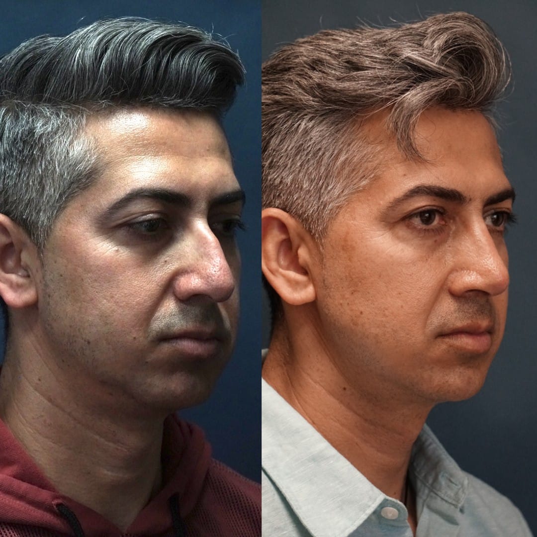 Rhinoplasty Before & After Gallery - Patient 58233332 - Image 3