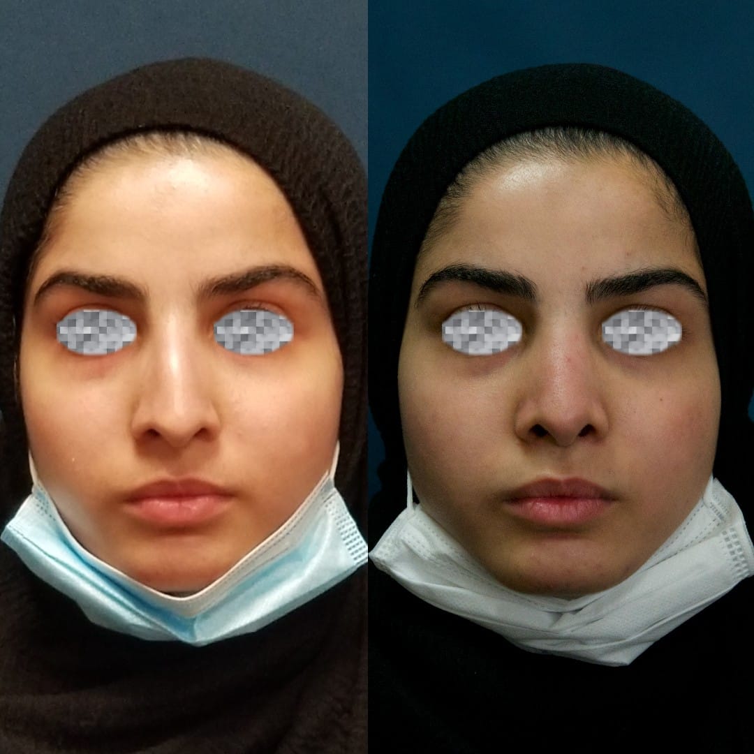 Rhinoplasty Before & After Gallery - Patient 58233333 - Image 2