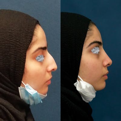 Rhinoplasty Before & After Gallery - Patient 58233333 - Image 1