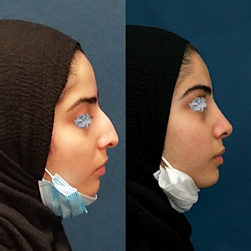 Rhinoplasty Before & After Gallery - Patient 58233333 - Image 1
