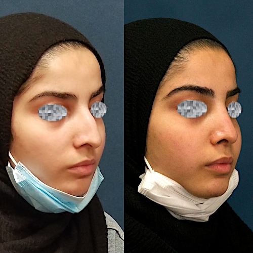 Rhinoplasty Before & After Gallery - Patient 58233333 - Image 3
