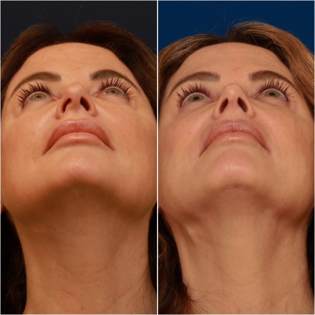Rhinoplasty Before & After Gallery - Patient 58233334 - Image 2