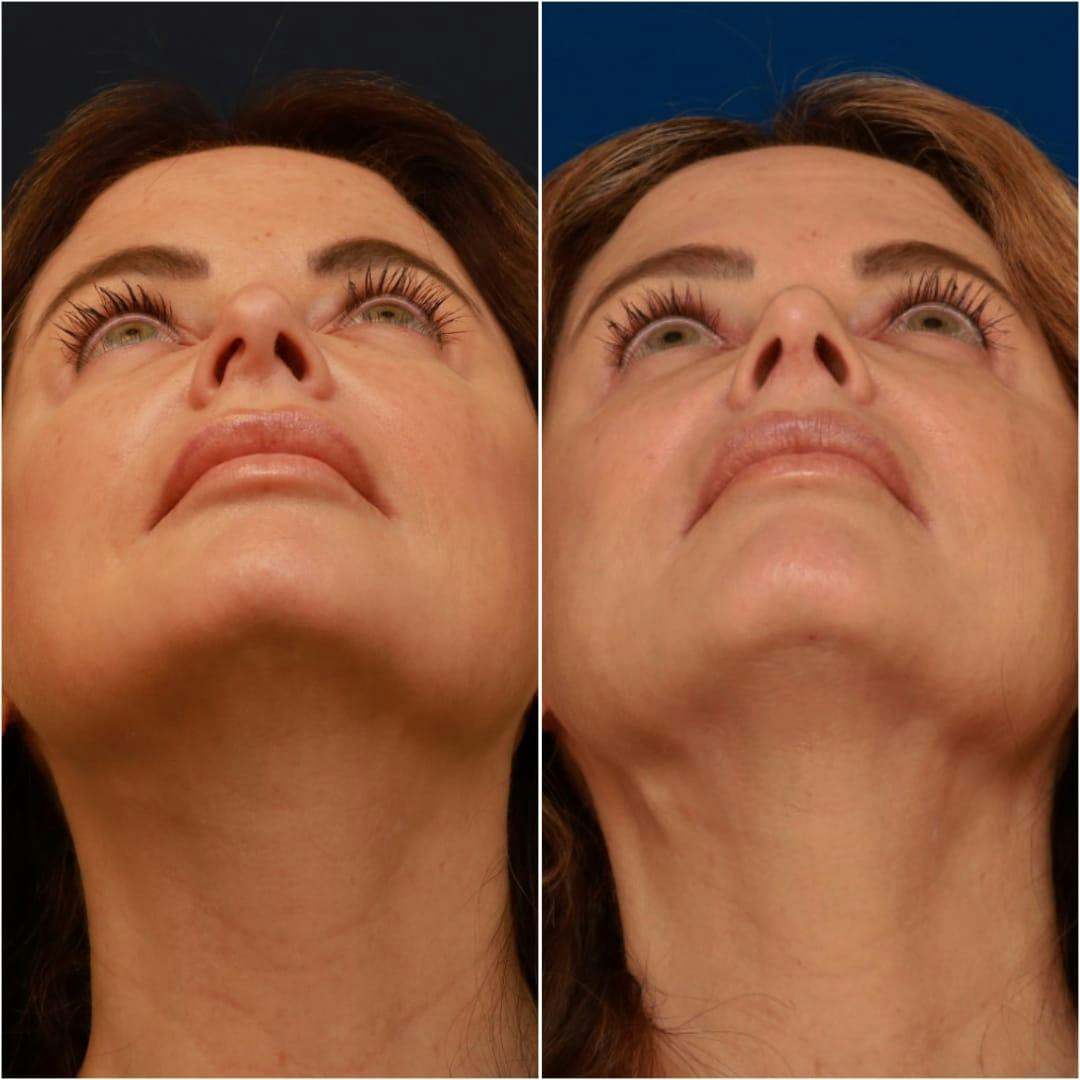 Rhinoplasty Before & After Gallery - Patient 58233334 - Image 2