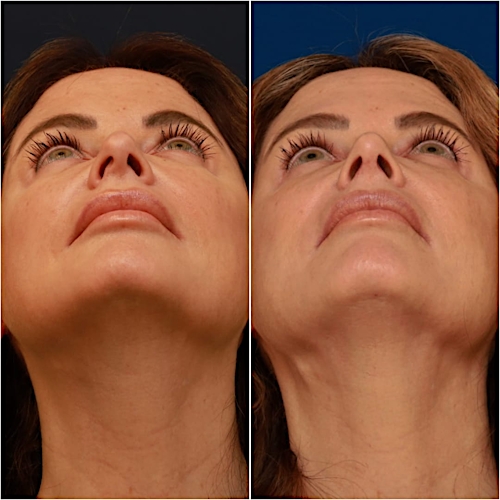 Rhinoplasty Before & After Gallery - Patient 58233334 - Image 2