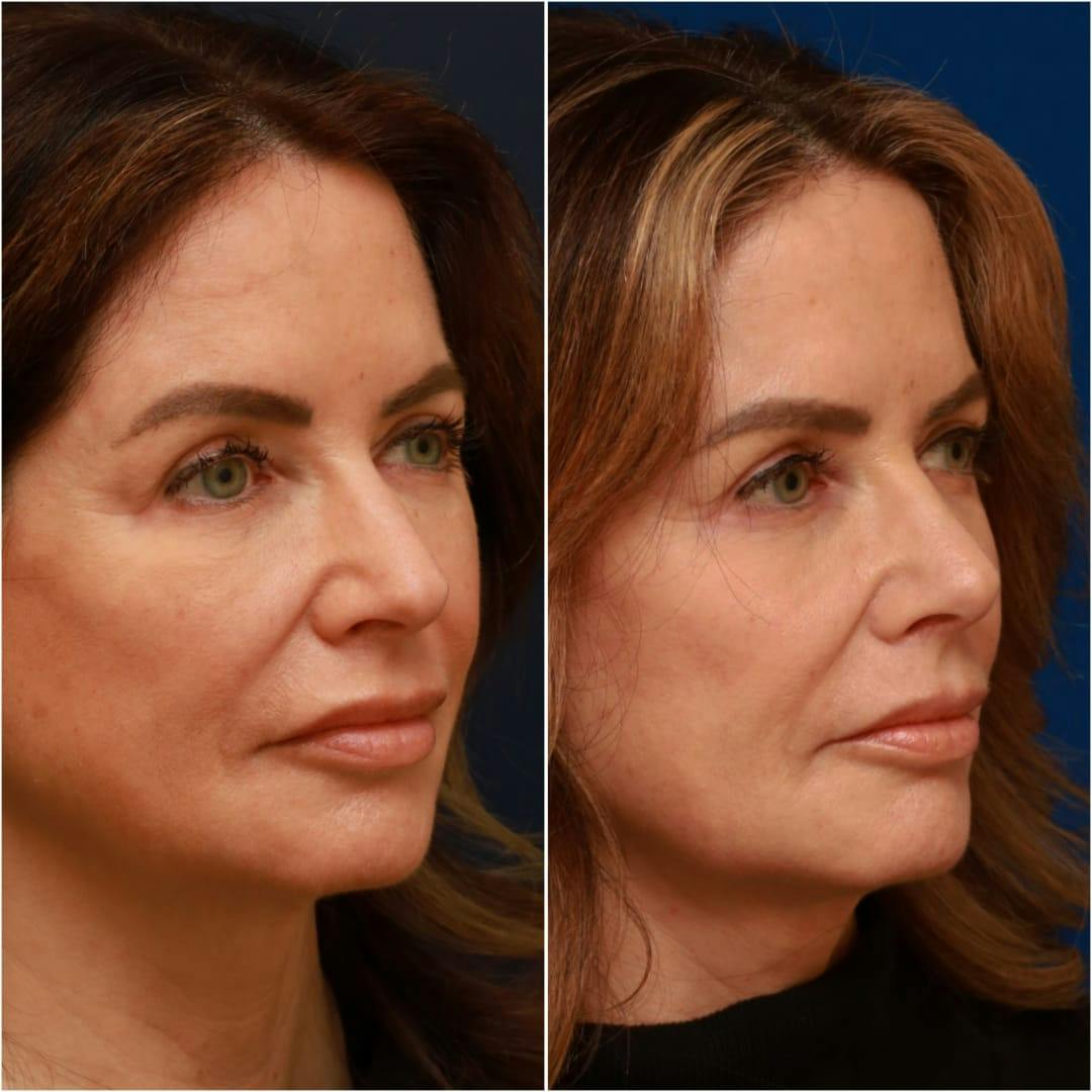 Rhinoplasty Before & After Gallery - Patient 58233334 - Image 3