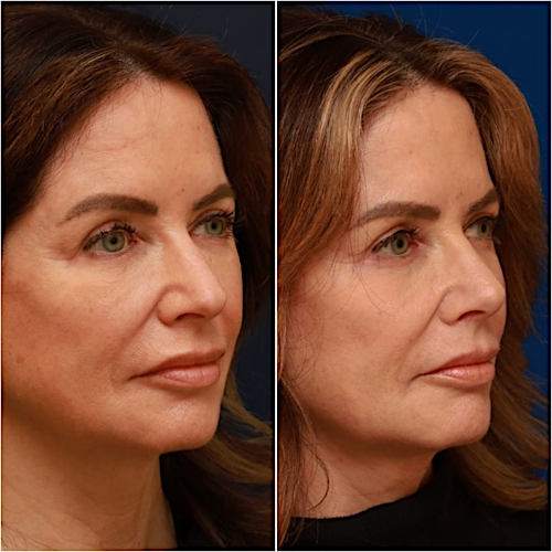 Rhinoplasty Before & After Gallery - Patient 58233334 - Image 3