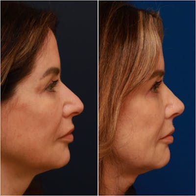 Rhinoplasty Before & After Gallery - Patient 58233334 - Image 1