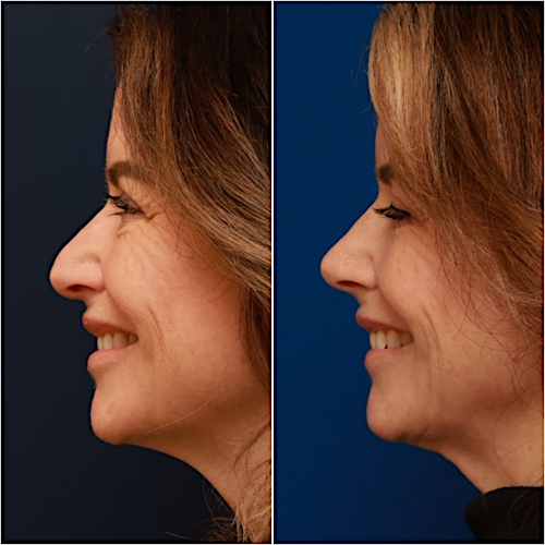 Rhinoplasty Before & After Gallery - Patient 58233334 - Image 4