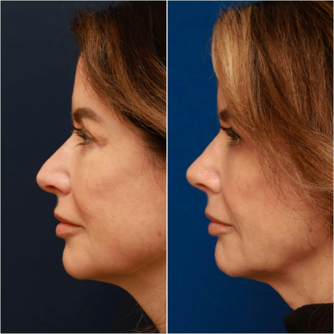 Rhinoplasty Before & After Gallery - Patient 58233334 - Image 5