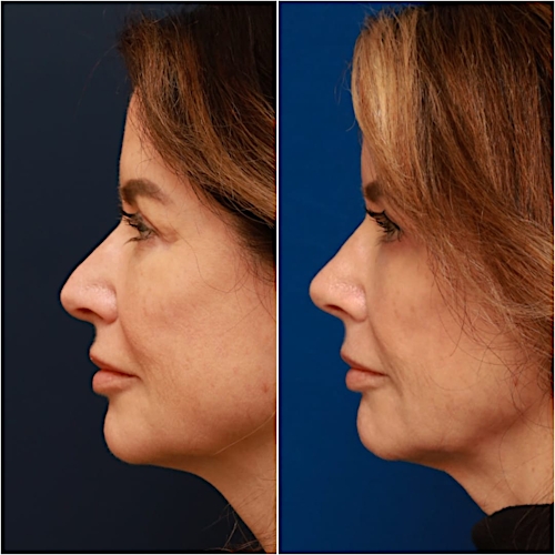 Rhinoplasty Before & After Gallery - Patient 58233334 - Image 5