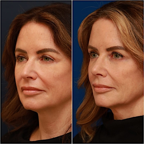 Rhinoplasty Before & After Gallery - Patient 58233334 - Image 6
