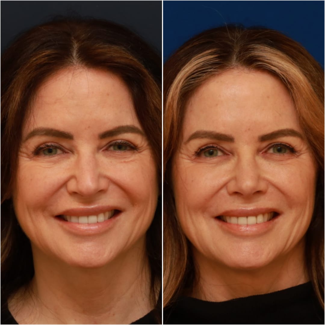 Rhinoplasty Before & After Gallery - Patient 58233334 - Image 7