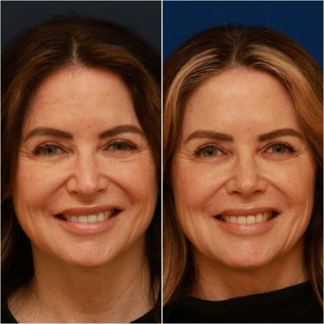 Rhinoplasty Before & After Gallery - Patient 58233334 - Image 7