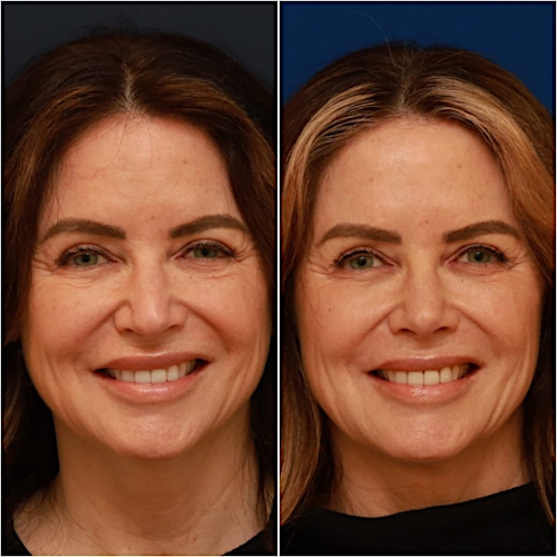 Rhinoplasty Before & After Gallery - Patient 58233334 - Image 7