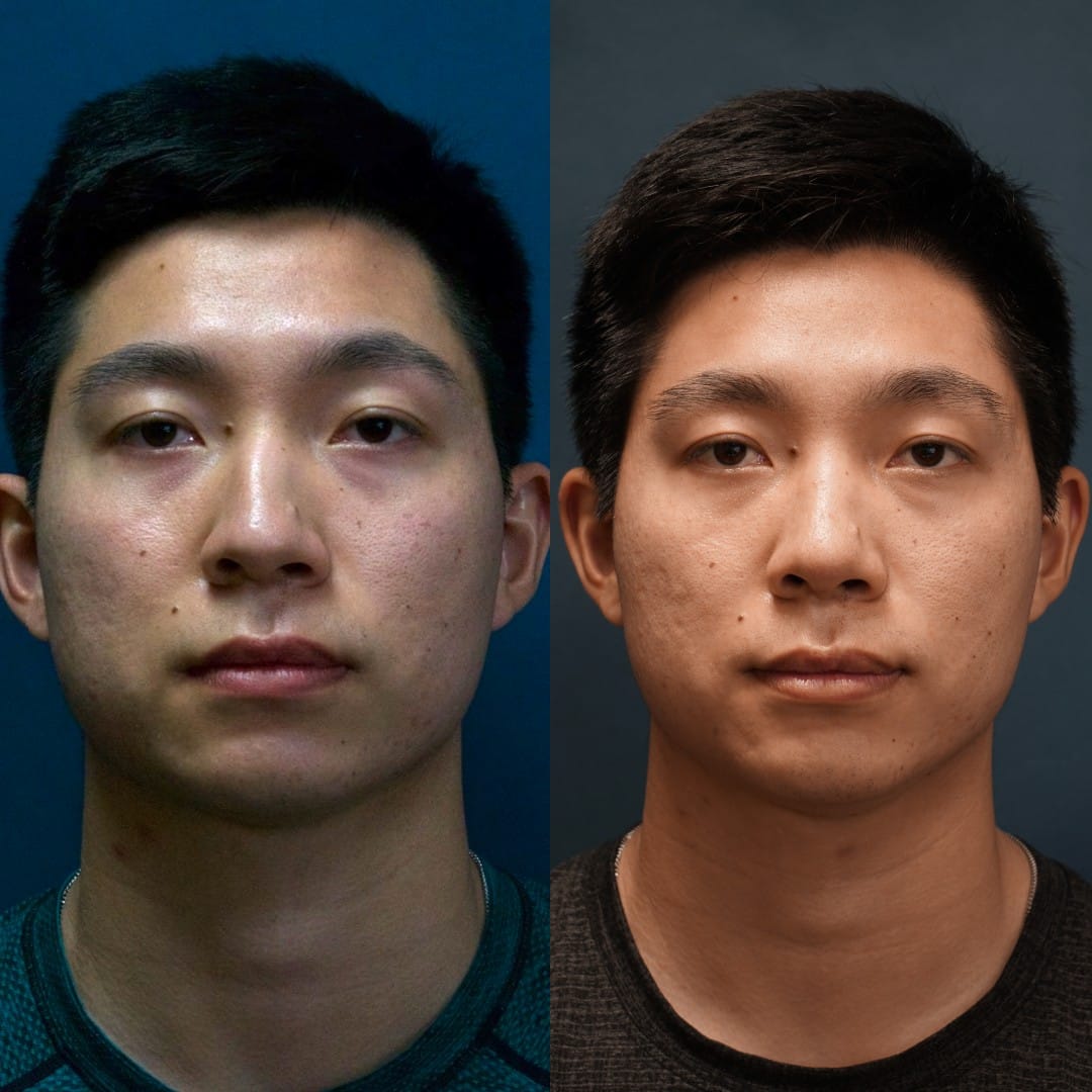 Rhinoplasty Before & After Gallery - Patient 58233335 - Image 2