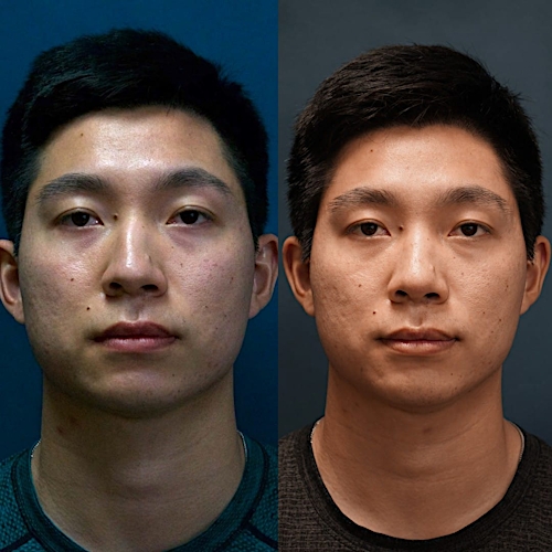 Rhinoplasty Before & After Gallery - Patient 58233335 - Image 2