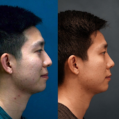 Rhinoplasty Before & After Gallery - Patient 58233335 - Image 1