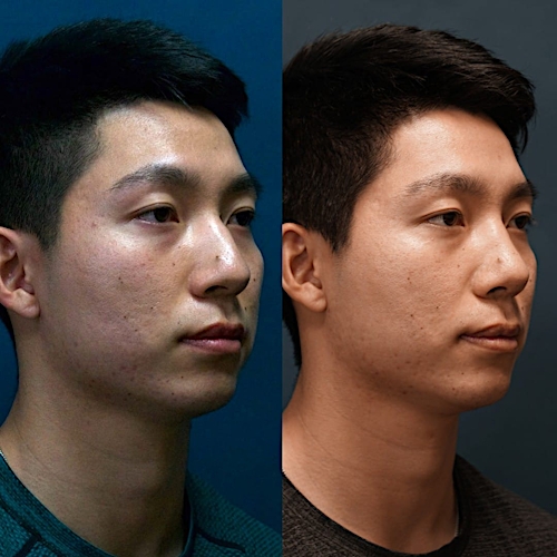 Rhinoplasty Before & After Gallery - Patient 58233335 - Image 3