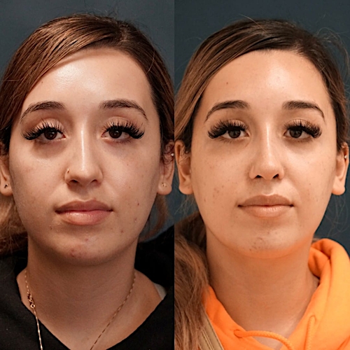 Rhinoplasty Before & After Gallery - Patient 58233336 - Image 2