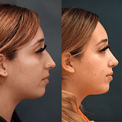Rhinoplasty Before & After Gallery - Patient 58233336 - Image 1