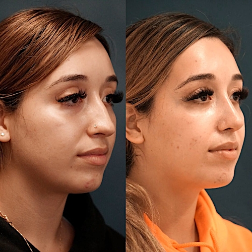 Rhinoplasty Before & After Gallery - Patient 58233336 - Image 3