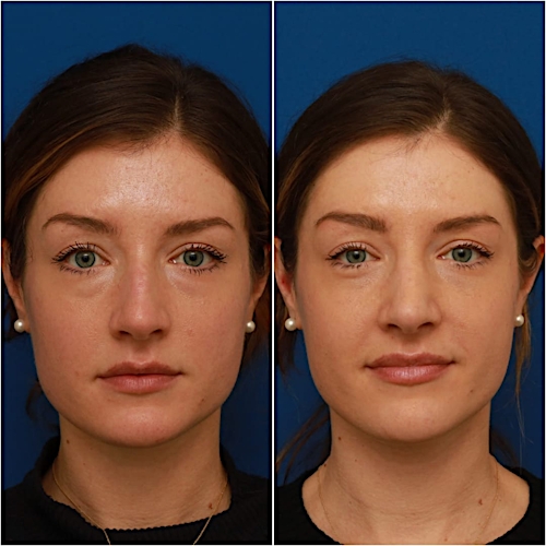 Rhinoplasty Before & After Gallery - Patient 58233337 - Image 2