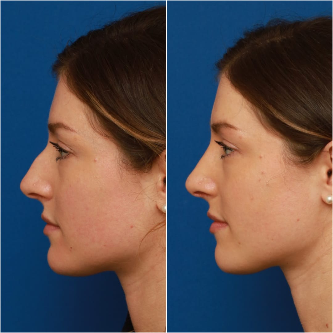 Rhinoplasty Before & After Gallery - Patient 58233337 - Image 3