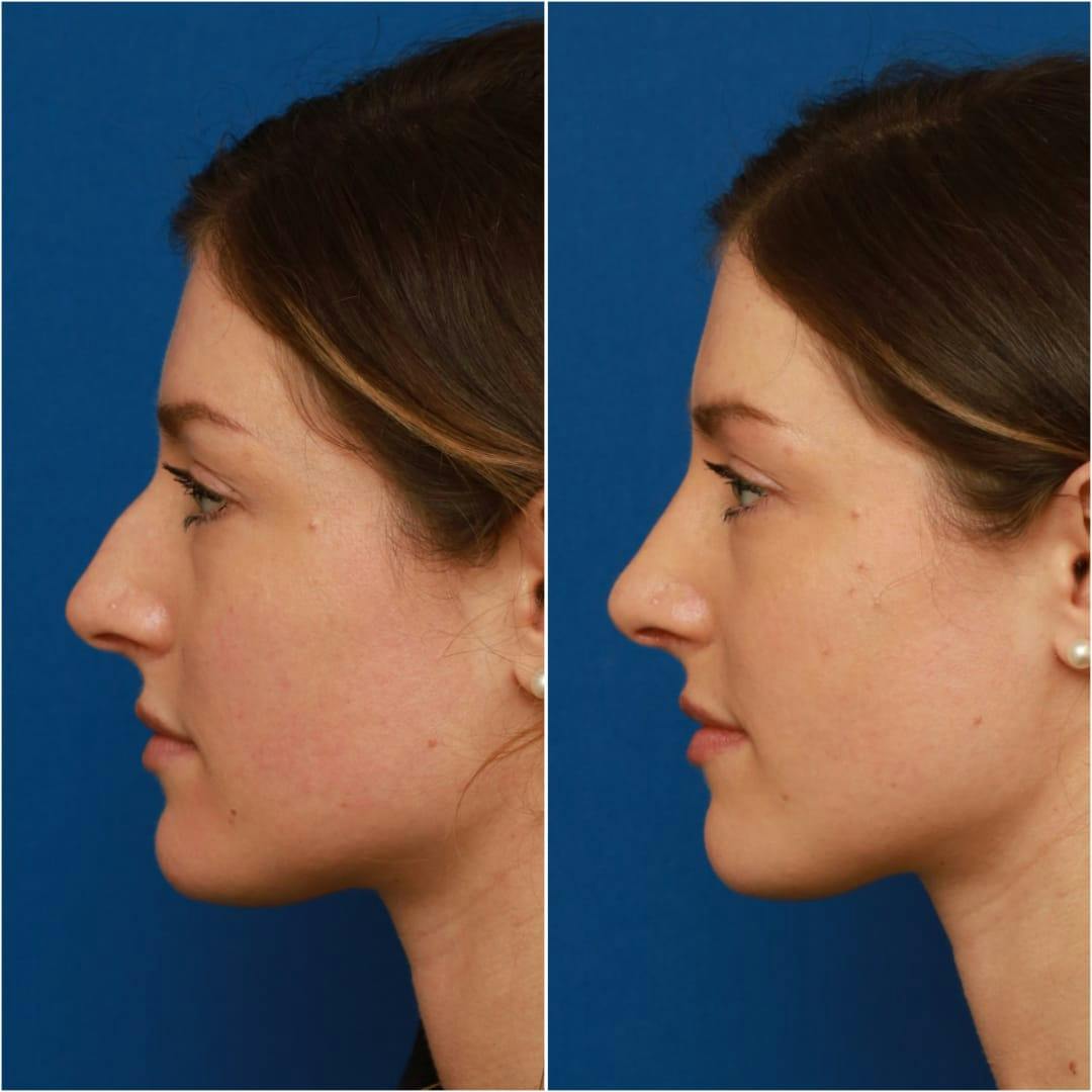 Rhinoplasty Before & After Gallery - Patient 58233337 - Image 3