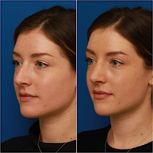 Rhinoplasty Before & After Gallery - Patient 58233337 - Image 4
