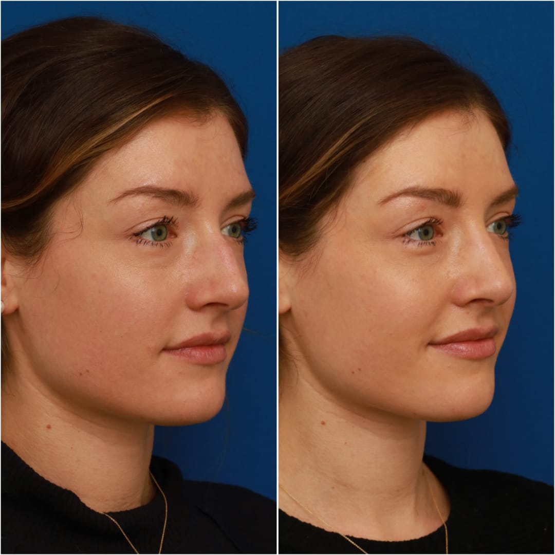 Rhinoplasty Before & After Gallery - Patient 58233337 - Image 5