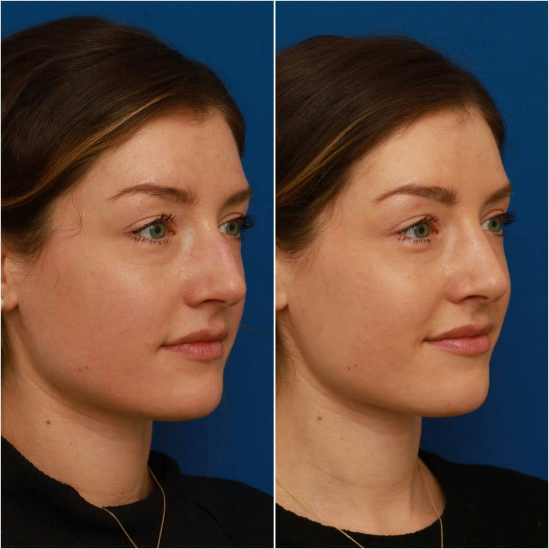 Rhinoplasty Before & After Gallery - Patient 58233337 - Image 5