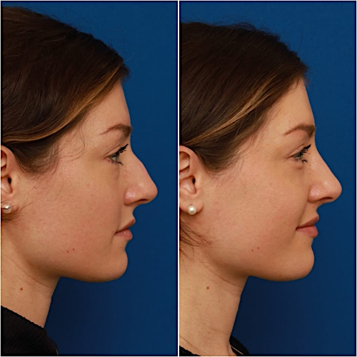 Rhinoplasty Before & After Gallery - Patient 58233337 - Image 1