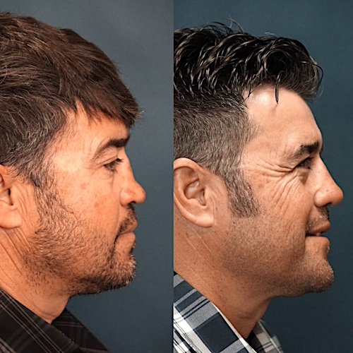 Revision Rhinoplasty Before & After Gallery - Patient 58233348 - Image 1