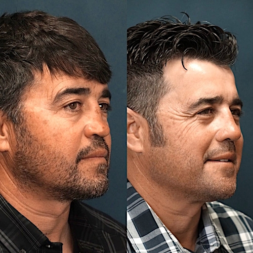 Revision Rhinoplasty Before & After Gallery - Patient 58233348 - Image 3