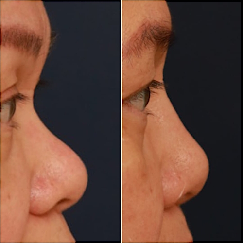 Non-Surgical Rhinoplasty Before & After Gallery - Patient 58233361 - Image 2