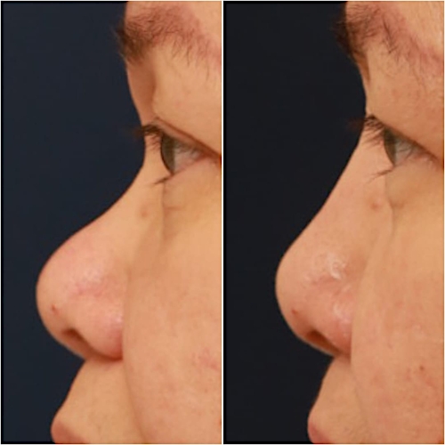Non-Surgical Rhinoplasty Before & After Gallery - Patient 58233361 - Image 1