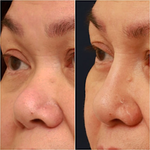 Non-Surgical Rhinoplasty Before & After Gallery - Patient 58233361 - Image 3