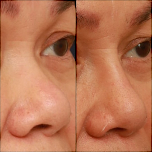 Non-Surgical Rhinoplasty Before & After Gallery - Patient 58233361 - Image 4
