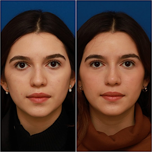 Non-Surgical Rhinoplasty Before & After Gallery - Patient 58233360 - Image 2