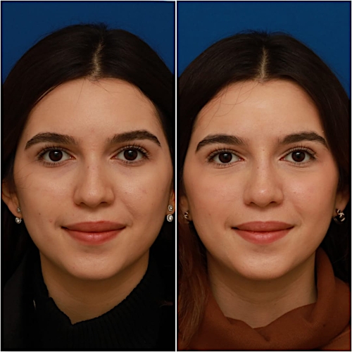 Non-Surgical Rhinoplasty Before & After Gallery - Patient 58233360 - Image 3