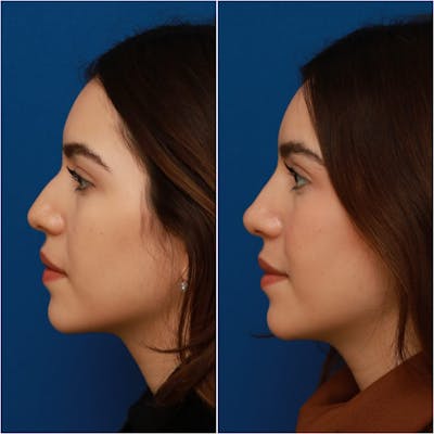 Non-Surgical Rhinoplasty Before & After Gallery - Patient 58233360 - Image 1