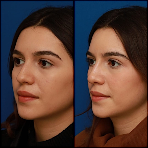 Non-Surgical Rhinoplasty Before & After Gallery - Patient 58233360 - Image 4