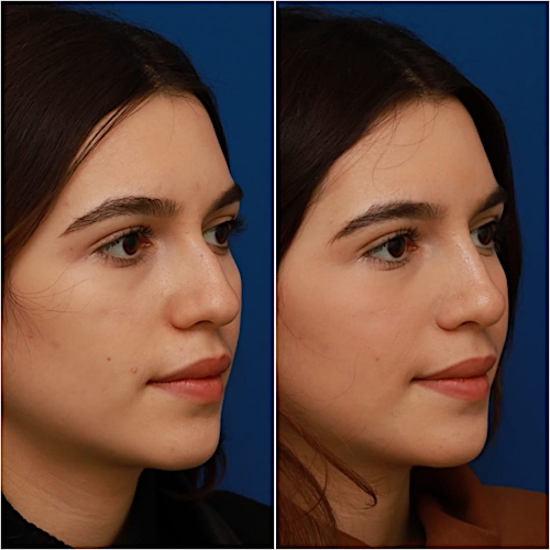 Non-Surgical Rhinoplasty Before & After Gallery - Patient 58233360 - Image 5