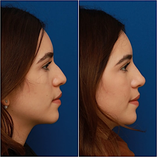 Non-Surgical Rhinoplasty Before & After Gallery - Patient 58233360 - Image 6