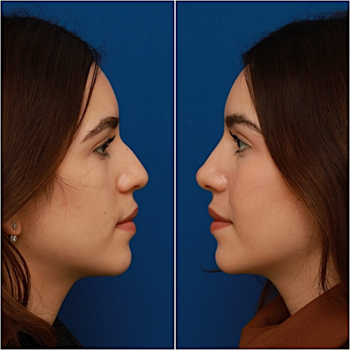 Non-Surgical Rhinoplasty Before & After Gallery - Patient 58233360 - Image 7