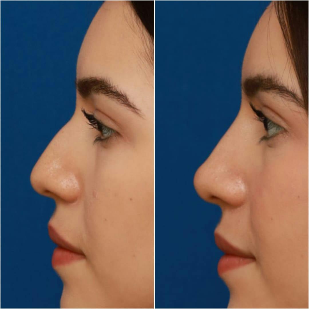 Non-Surgical Rhinoplasty Before & After Gallery - Patient 58233360 - Image 8