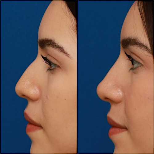 Non-Surgical Rhinoplasty Before & After Gallery - Patient 58233360 - Image 8